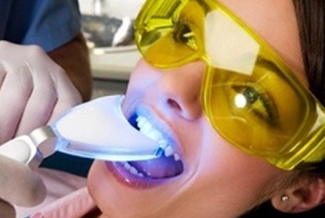 سفید کردن دندان با اشعه