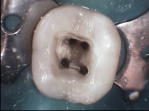 عصب کشی دندان 2