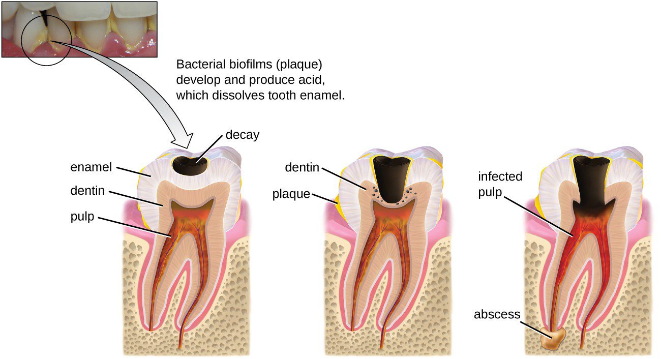 روند پوسیدگی دندان