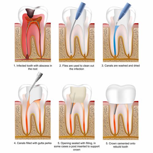مراحل درمان ریشه دندان