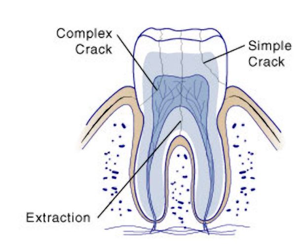 تقسیم بندی شکستگی دندان