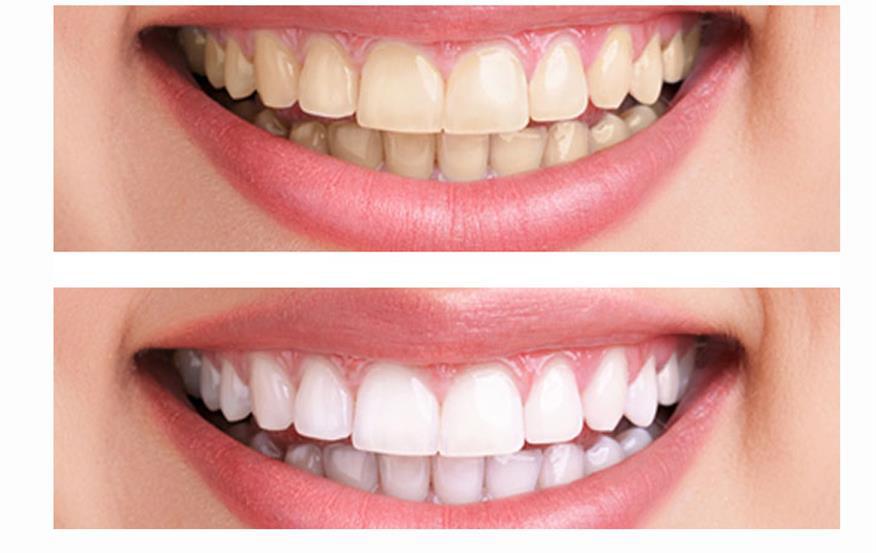سفید کردن دندان در اصلاح طرح لبخند