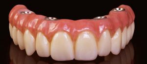 دندان مصنوعی ثابت ساخته شده