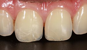 ترک عامل حساسیت دندان