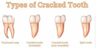 انواع شکستگی دندان