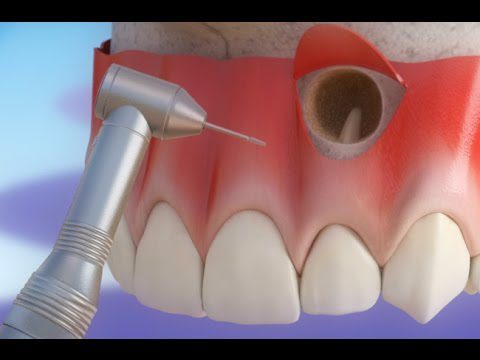 جراحی ریشه دندان با دستگاه
