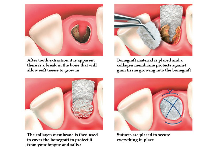 پیوند در محل کشیدن دندان