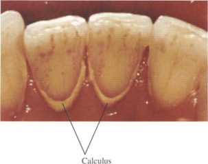نمای جرم دندان
