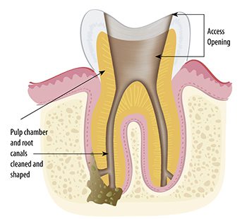 دسترسی عصب کشی دندان