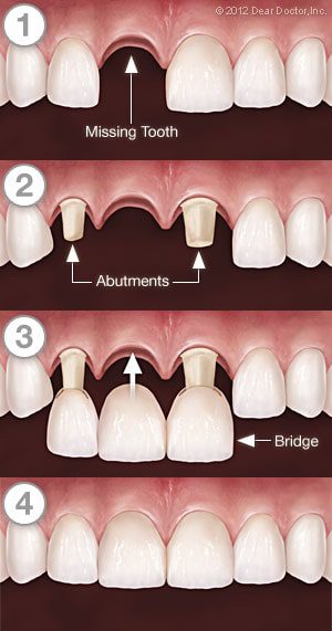 مراحل بریج دندان جلو