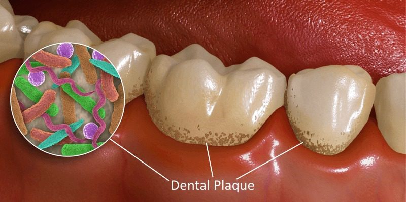 پلاک میکروبی عامل پوسیدگی دندان