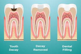 برداشتن پوسیدگی دندان