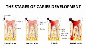 مراحل پیشرفت پوسیدگی دندان