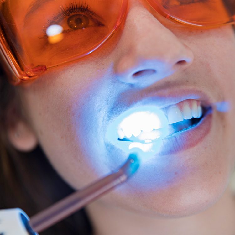 پر کردن دندان با کامپوزیت نوری