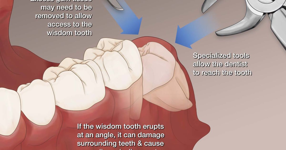 کشیدن راه حل درد دندان عقل