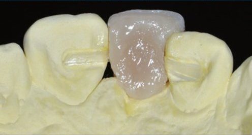 کاشت دندان با بریج FRC