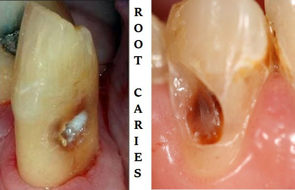 درمان پوسیدگی ریشه دندان