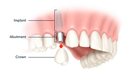 کاشت دندان با ایمپلنت