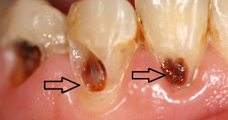 پوسیده شدن ریشه دندان