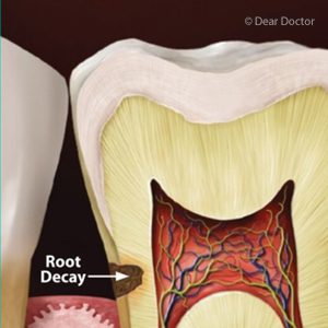 پوسیدگی ریشه دندان