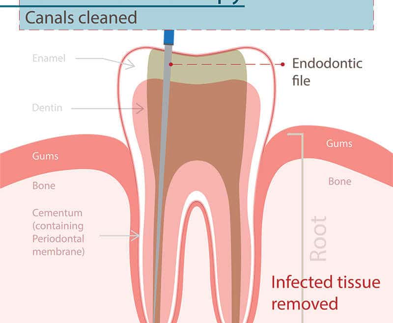 پر کردن کانال دندان