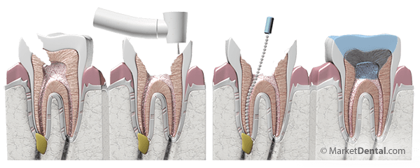 مرحله پاکسازی کانال دندان