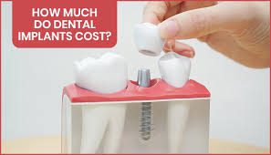 قیمت ایمپلنت دندان
