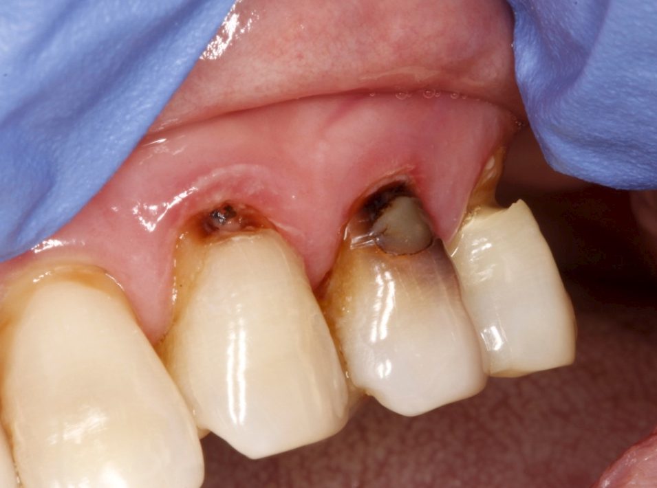 پوسیدگی دندان نیش