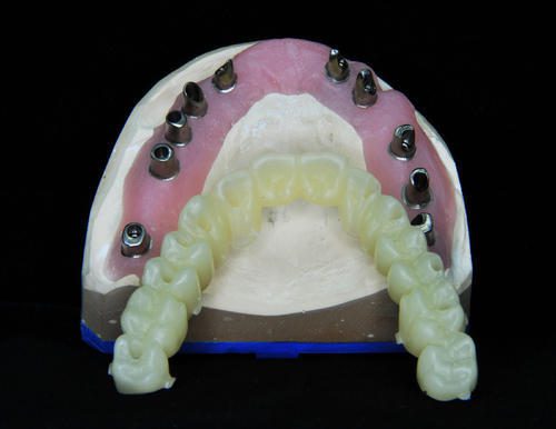 ایمپلنت دندان مصنوعی