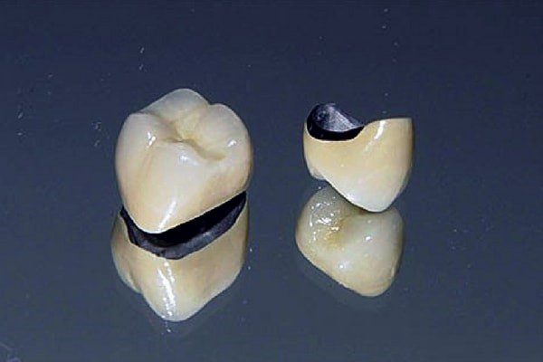 روکش دندان PFM