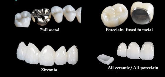 انواع روکشهای دندانی
