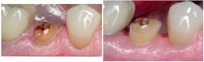 افزایش طول تاج دندان عصب کشی شده