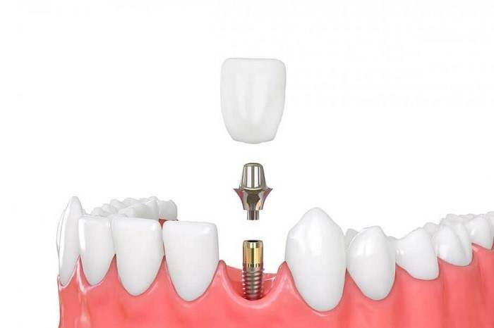 ایمپلنت پایه روکش دندان می شود