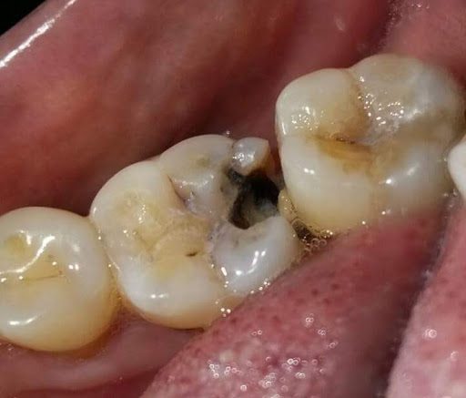 چرا دندان پوسیده می شود