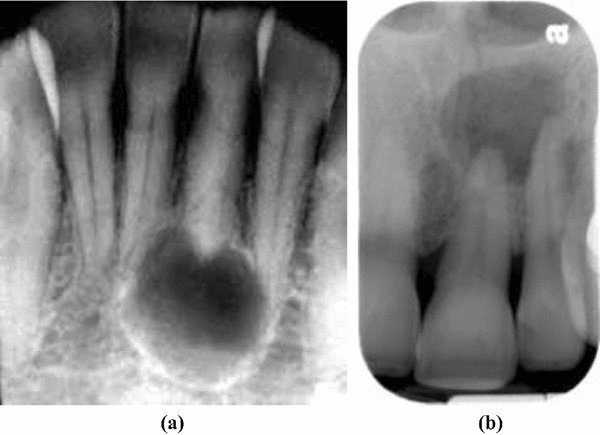 رادیوگرافی کیست دندان
