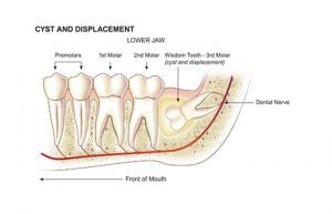 انواع کیست دندان