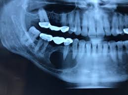 نمای کیست دندان