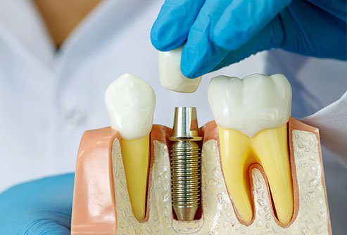 همه چیزهایی که باید درباره ایمپلنت دندان بدانید