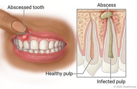 ایمپلنت دندان عفونی