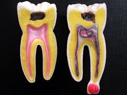 انواع دندان عفونی
