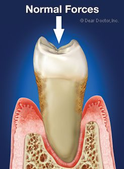 ایمپلنت دندان لق