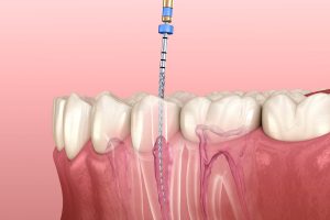 راه های جلوگیری از عصب کشی دندان
