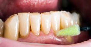 خشکی دهان و پوسیدگی دندان