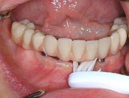 نخ دندان زیر بریج