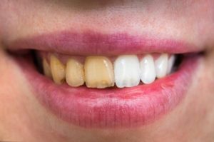 درمان زردی دندان