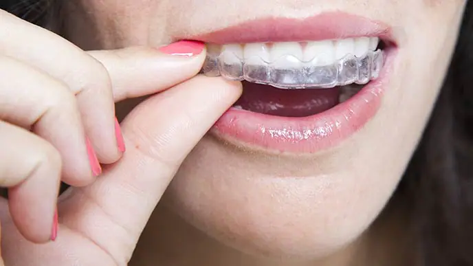 ردیف کردن دندانها با ارتودنسی نامرئی