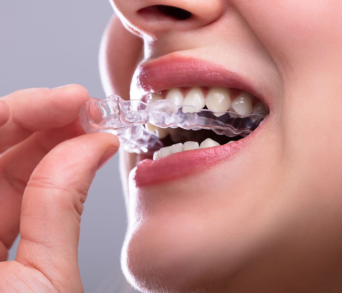 مزایا و معایب ارتودنسی نامرئی برای ردیف کردن دندانها