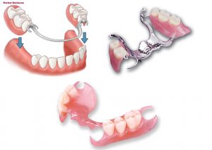 دندان مصنوعی جزئی فلزی