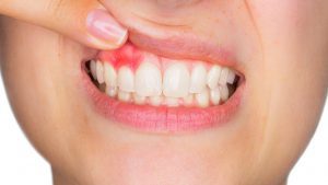 درمان التهاب لثه دندان