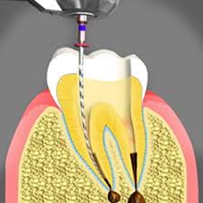 عصب کشی مجدد دندان چیست؟